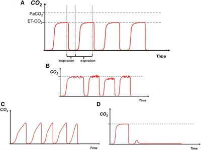 Capnography waveforms: basic interpretation in neonatal intensive care